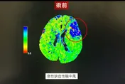 婦腦中風合併顱內動脈瘤！2小時內取栓隔日出ICU