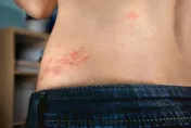 氣溫忽冷忽熱「皮蛇」伺機爆發　中西醫整合提升免疫力
