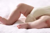 孩子輕碰就瘀青？3歲童摔倒「膝蓋腫如橘子」確診血友病