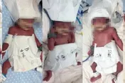 影/6000萬分之一的奇蹟！新疆24歲女順利產下「1男4女」五胞胎
