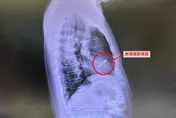 她長期頭暈、昏倒查病因　醫驚：一天「心跳驟停5000次」恐猝死