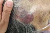討錢不成！屏東逆孫狂毆90歲嬤　全身瘀青、腦出血送ICU