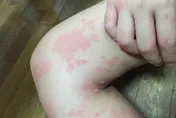 兒童蕁麻疹不只是過敏問題！「風熱濕入侵」才是關鍵成因