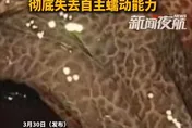 嚇！陸女狂喝通便茶10年赫見「豹紋腸」　發黑壞死切30cm