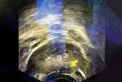 6旬男怕術後失性功能！選「海神刀」消融攝護腺癌零傷口