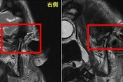 顳顎關節痛成文明病？跨領域整合醫療「玻尿酸+震波」改善症狀