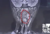6歲陸童狂打呼！咽喉藏「雞蛋大腫瘤」　醫驚：未發育雙胞胎