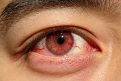 眼睛癢到抓狂恐是過敏性結膜炎！熱敷、揉眼反加重病情