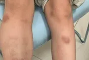 不是血癌！6歲童全身瘀青　醫：體內這種蟲卵爆滿...