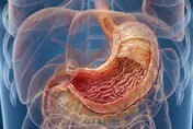 39歲女無症狀健檢！「不到1公分潰瘍」竟是高惡性胃癌