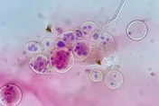 手腳痠麻、四肢無力竟是骨轉移釀神經壓迫！醫：嚴重恐癱瘓