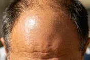 洗頭一抓掉髮滿手？中醫：從「肝腎氣血」根治才是正解