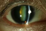 白內障拖太久恐釀青光眼！醫警告：視力模糊應及早就醫