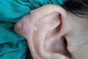 穿耳洞竟變「精靈耳」！19歲女耳廓蟹足腫外凸變形