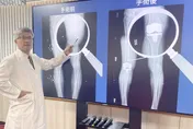 玻尿酸打3年沒改善！「機械手臂換膝」舞蹈老師重返舞台