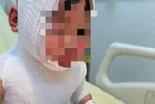 1歲半童遭滾燙咖啡淋身「皮剝落」　三度手術如地獄！母痛心發文