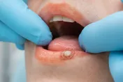 唇皰疹、口角炎、口腔潰瘍差很大！營養師：對症補營養才有效