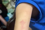 幼兒園涉虐童！家長心疼兒手臂大片瘀青　基隆市府要嚴查了