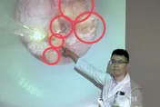 追劇忘喝水！婦半年三度腎結石　雙腎佈滿結石如雜糧麵包