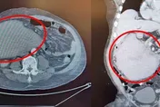 男遭踹一腳險喪命　醫：罕見十二指腸後腹腔大出血