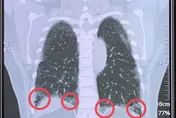 越喘越不敢動、然後更喘！醫：惡性循環正在傷害你的肺