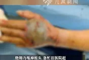 斷頭竟「跳起來咬人」！陸7旬翁斬眼鏡蛇頭遭咬　左手發黑險沒命