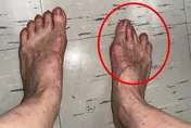 出國走兩萬步腳趾腫爆！醫警告：拇趾外翻恐痛到回不了家