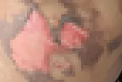 拔罐慘被燒！火苗突掉落「引燃床單」　陸女皮膚燒掉慘不忍睹