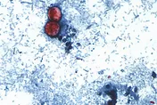 美國環孢子蟲疫情達1.8萬例釀2死　當局已鎖定感染源頭之一