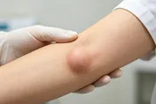 腫塊不痛不癢就沒事？6旬翁拖多年竟長成17公分骨腫瘤