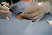 甲狀腺結節一定要開刀？60歲婦靠「射頻消融」縮小腫塊
