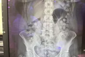 影/吞72顆毒膠囊！泰拳女教練走私360萬海洛因　10天排出
