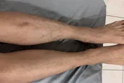 雙腿潰瘍痛到走不了！25歲男「幹細胞移植」擺脫罕病