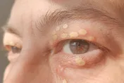 身上長4種黃色瘤？血管油脂恐已滿溢　醫：當心腦中風！