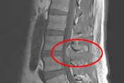他腰痛發燒2週不是感冒！檢查竟發現細菌入侵脊椎、心臟