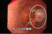 長期胃食道逆流竟吐血！竹科男確診食道癌