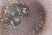 自行掏耳朵嚇壞！耳道驚見「一坨黑色珍珠」竟是痣