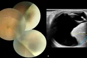 36歲女眼內有巨大腫瘤！北榮切除2公分惡性瘤保住視力