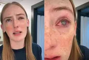阿米巴原蟲入侵！美19歲少女「戴隱形眼鏡洗澡」慘失明