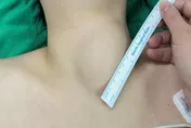 脖子卡卡、吞嚥不順！30多歲女揪出8公分甲狀腺結節