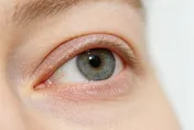 乾眼症狂眨眼還是乾？熱敷、睡眠、補維生素D助改善