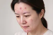 額頭、下巴輪流冒痘別再用手擠！中醫師提醒小心發炎留疤