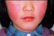 大叫一聲猝死！11歲女童驗出「B19病毒」非流感　日本曾大流行