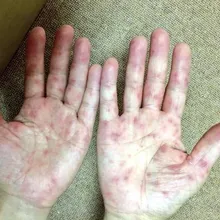 今年首例！10多歲男童手腳無力「竟是腸病毒重症」