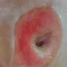 嚇！陸女誤把「皮脂腺囊腫」當痘痘擠　臉部驚現「恐怖黑洞」