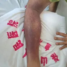 誤踩蛇窩遭狂咬12口！雲南男休克命危　5天搶救奇蹟生還