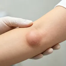 腫塊不痛不癢就沒事？6旬翁拖多年竟長成17公分骨腫瘤