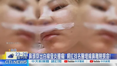 【每日必看】鼻頭穿出白線發炎腫痛! 網紅找名醫埋線鼻雕險喪命! 20260612