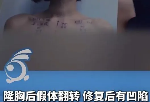 陸女砸17萬隆胸「一翻身就塌」 院方稱可能「尺寸太小」