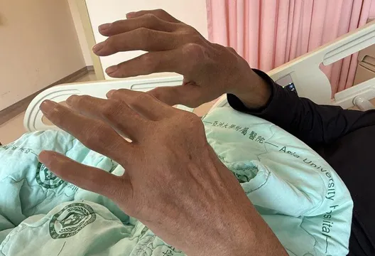 男子痛風石如雞蛋大破裂　醫：嚴重恐截肢